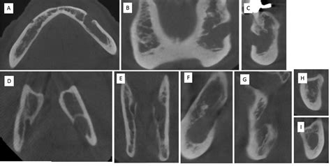 Mandibular Foramen Radiograph