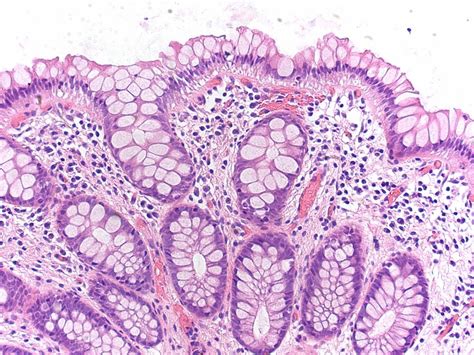 Hyperplastic polyp (goblet cell subtype) | Hyperplastic poly… | Flickr