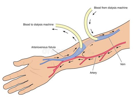 Dialysis Arteriovenous Fistula Stock Vector - Illustration of ...