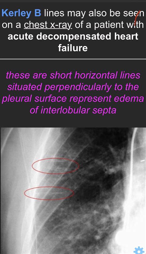 Why are kerley b lines also seen in decompensated heart failure? : r/step1