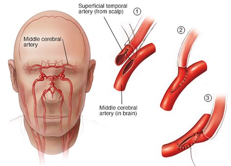 Moyamoya Disease - Causes, Symptoms, Life Expectancy, Treatment