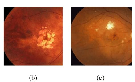 5 Symptoms of AMD in retinal fundus images. a) Dry AMD with drusen b ...