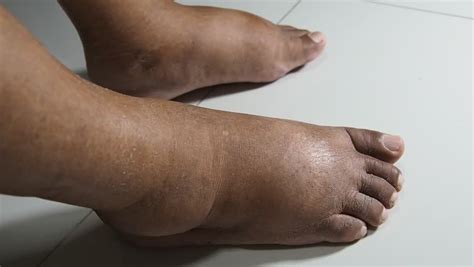 What causes Swollen feet? | Bansal Global Hospital