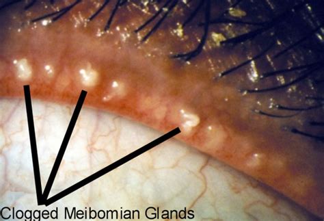 Sty Symptoms: What are the Indications of Eye Stye