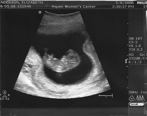 10+week+ultrasound (image)