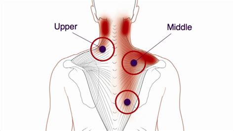 What are trigger points? — Flow Point Acupuncture- Red Bank Acupuncture