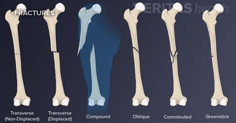 Compound Fracture Picture - Foto Kolekcija