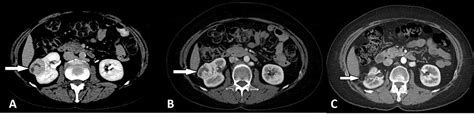 Renal Cell Carcinoma Mri