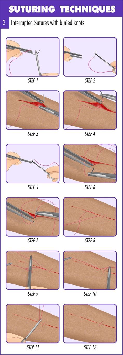 Surgical Suturing Techniques Mastery Guide - Apprentice Doctor ...