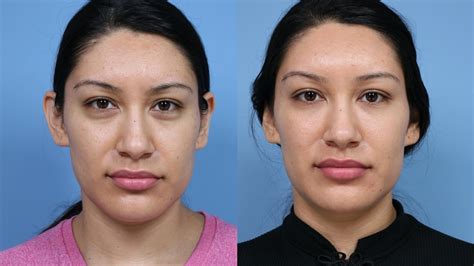 Facial Fillers Before and After Photo Gallery | Palo Alto & San Jose ...