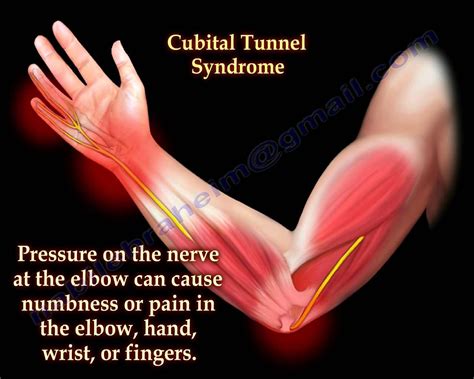 Cubital Tunnel Syndrome Ulnar Nerve Entrapment - Everything You Need To ...