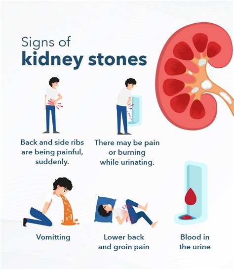 Behind the pain: The warning signs of Kidney Stones Symptoms