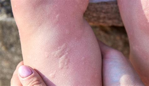 Cold Urticaria: What It Is, Symptoms, Causes & Treatment