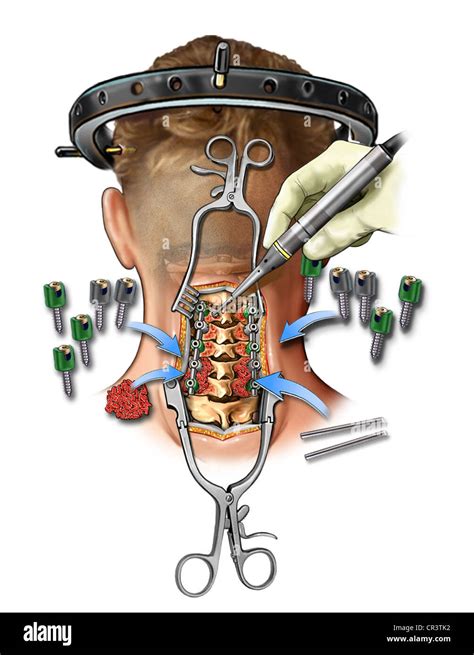 C3-7 Posterior Cervical Bone Fusion Stock Photo, Royalty Free Image ...