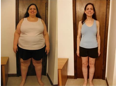 Gastric Sleeve Before and After Pictures and What You Can Expect ...