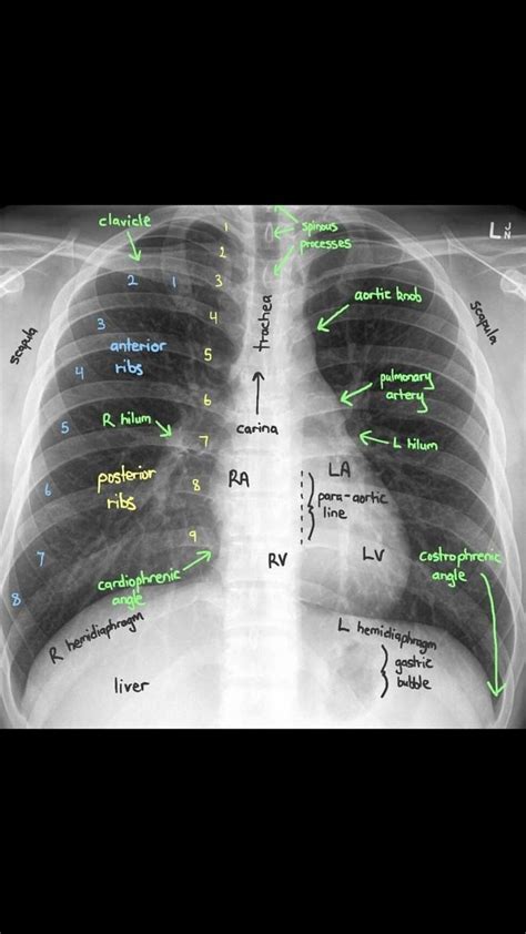 Very good X-ray description | Critical care nursing, Nursing school ...