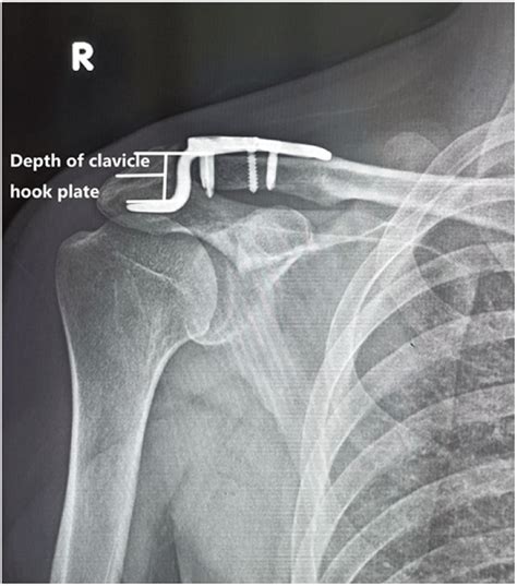 The depth of the hook plate used in the patient | Download Scientific ...