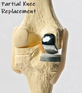 Partial Knee Replacement: Indications, Surgery & Recovery