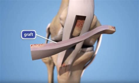 ACL Injury: Does It Require Surgery? - OrthoInfo - AAOS