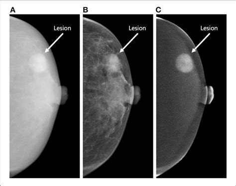 | Three types of contrast-enhanced mammography (CEM) images of the ...