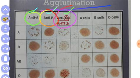 Blood group test ABO method by slide agglutination,Blood grouping test ...