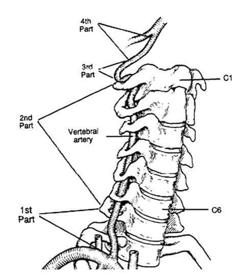 Vertebral Artery Injury - Spine - Orthobullets