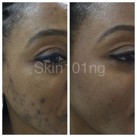 Hyperpigmentation Treatment: Before and After