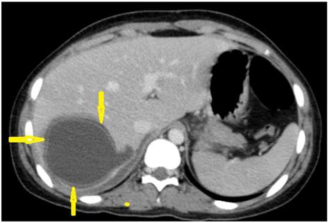 Diagnostics | Free Full-Text | Hydatid Disease: A Radiological ...