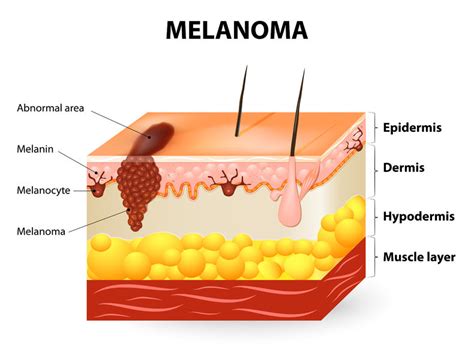 How To Spot The Early Signs Of Melanoma Skin Cancer | Babyface