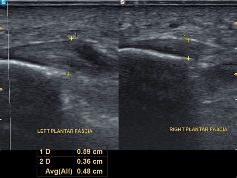 Foot & Ankle Ultrasounds - Harmonic Medical Sonography - Harmonic ...