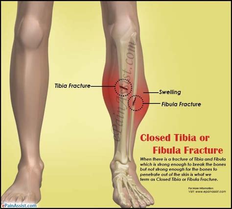 Closed fracture - hometraffic