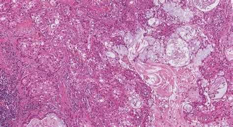 Mucoepidermoid Carcinoma Cytology