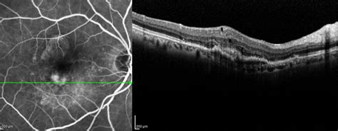 Pediatric Retina, Retina Services