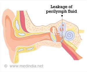 Perilymph Fistula - Frequently Asked Questions