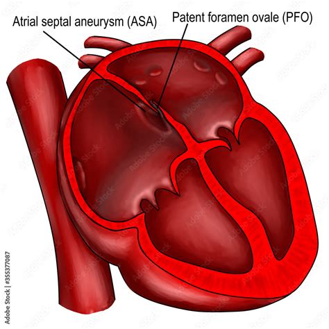 The patent foramen ovale and atrial septal aneurysm are the structural ...