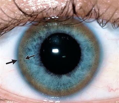 Kayser-Fleischer ring at the rim of cornea in a patient with - MEDizzy