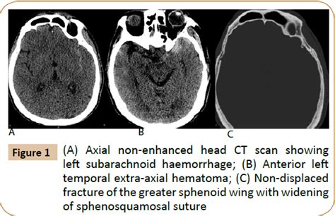 Endovascular Management of Ruptured Traumatic Middle Meningeal Artery ...