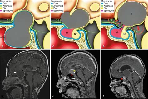 Classification for Craniopharyngioma and Histopathological Aspect ...