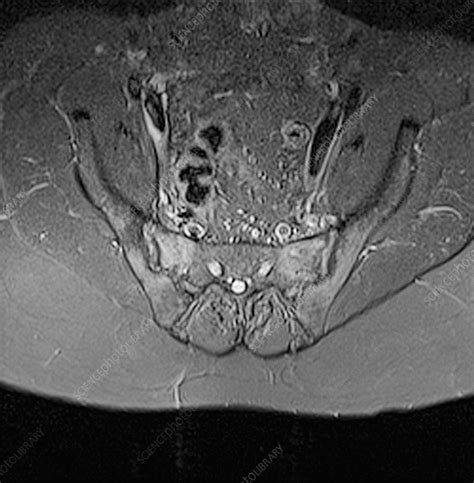 Sacroiliitis, MRI scan - Stock Image - C023/4417 - Science Photo Library