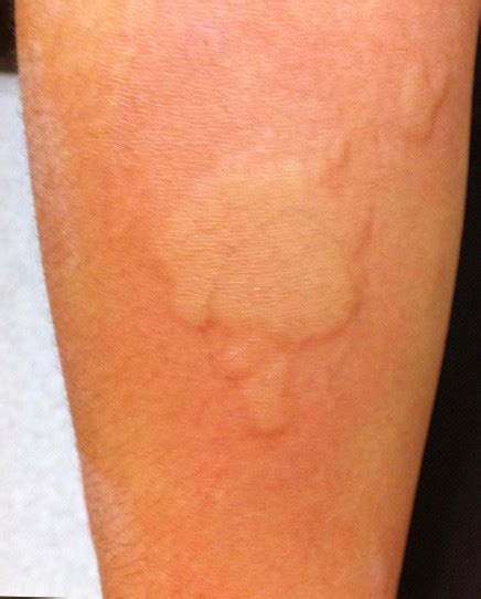 allergic reaction rash pictures - pictures, photos