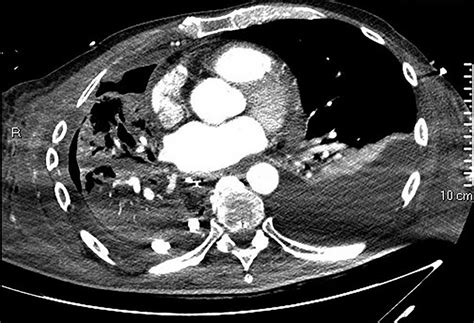 Initial CT showing a right hydropneumothorax after chest tube placement ...