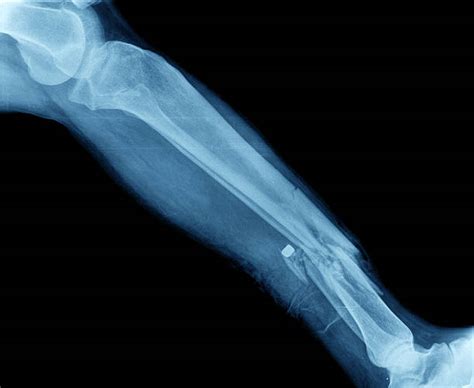 8,800+ Broken Bone Xray Stock Photos, Pictures & Royalty-Free Images ...