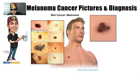 Melanoma Symptoms Stage 2 Doctor Heck | Free Hot Nude Porn Pic Gallery