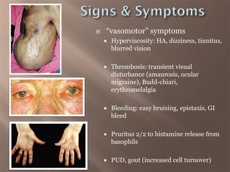 PPT - Polycythemia vera PowerPoint Presentation - ID:7007827