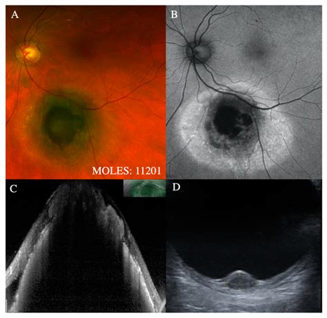 Choroidal Melanoma Oct