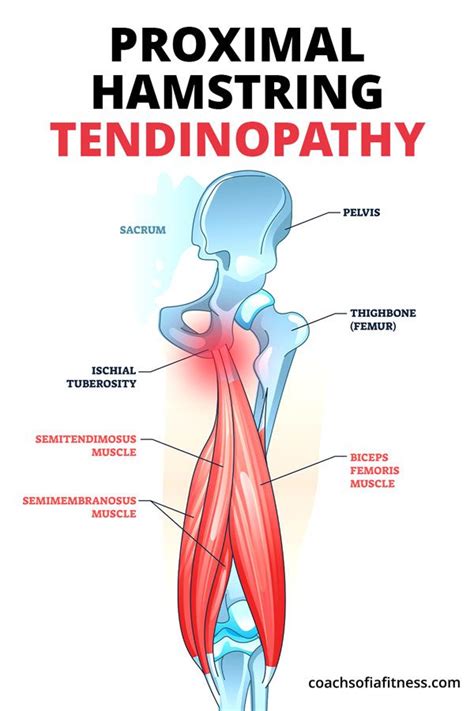 Hamstring Tendinopathy: Best Exercises for Relief - Bút Chì Xanh