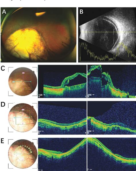 Figure 1 from Bilateral congenital uveal coloboma concurrent with ...