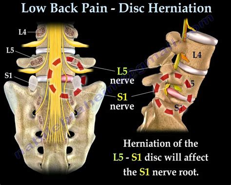 Low Back Pain - Disc Herniation ,Sciatica - Everything You Need To Know ...