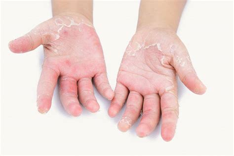 Treating Palmar/Plantar Psoriasis | The Dermatology Center Of Indiana