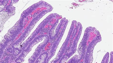 Villous adenoma of the colon | MyPathologyReport.ca